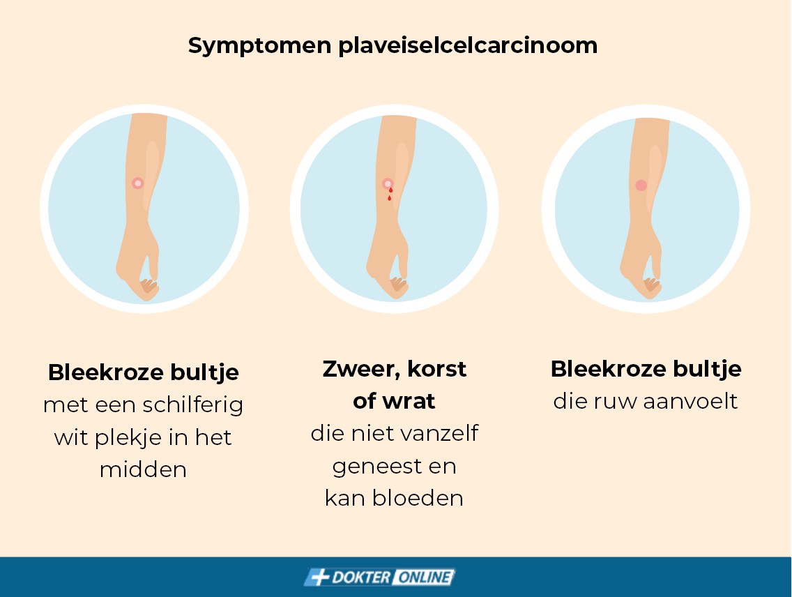 Symptomen plaveiselcelcarcinoom NL