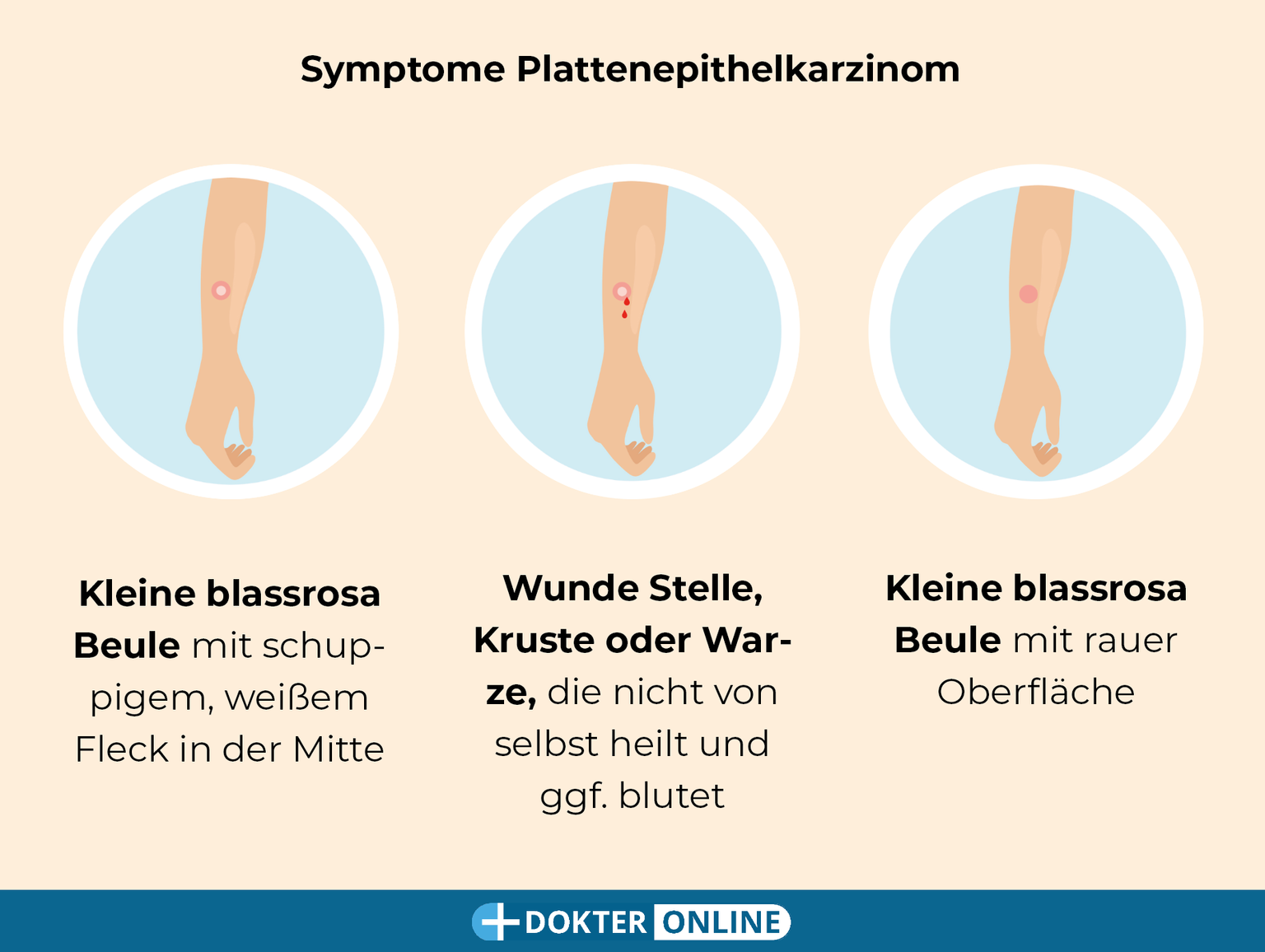 Hautkrebs durch Selbstuntersuchung frühzeitig erkennen - DE4