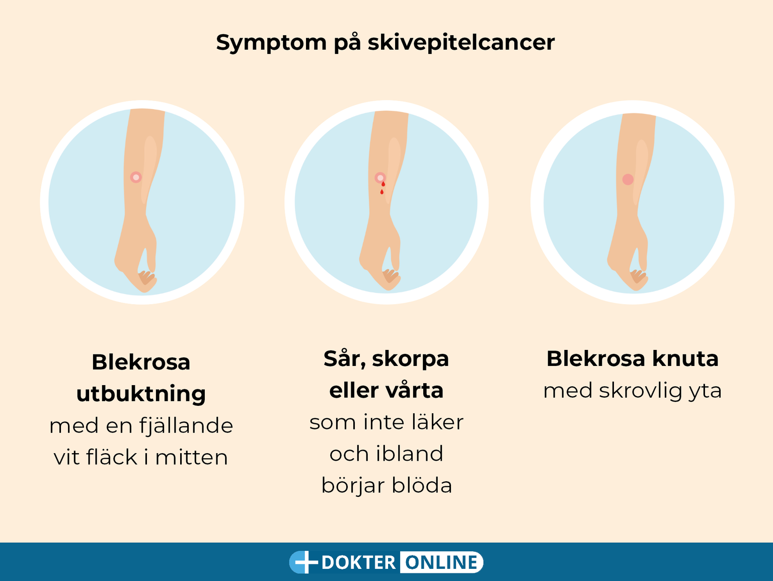 Tidig upptäckt av hudcancer genom självundersökning - SV4