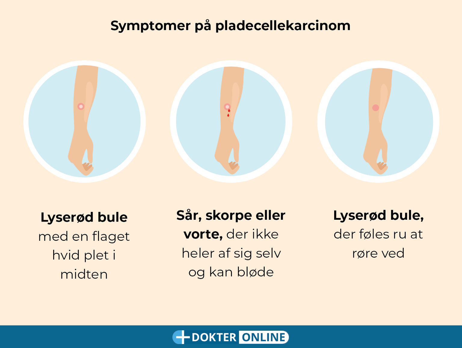 Tidlig opdagelse af hudkræft gennem selvundersøgelse - DK4