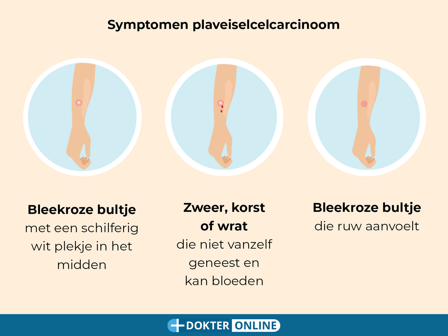 Vroegtijdige detectie van huidkanker door zelfonderzoek - NL4