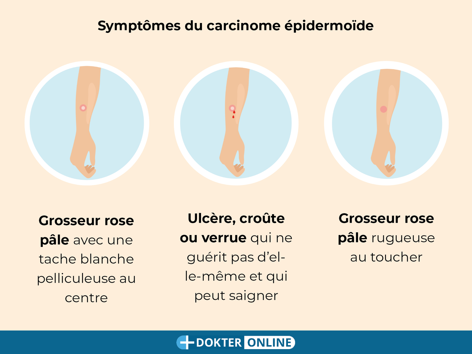 Détection précoce du cancer de la peau par l’autoexamen - FR4