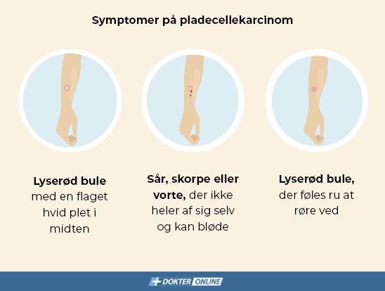 Symptomer på pladecellekarcinom - DA