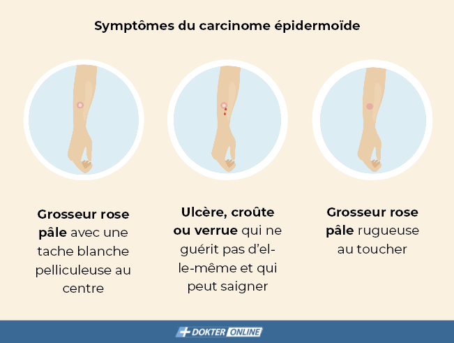 Symptômes du carcinome épidermoïde - FR