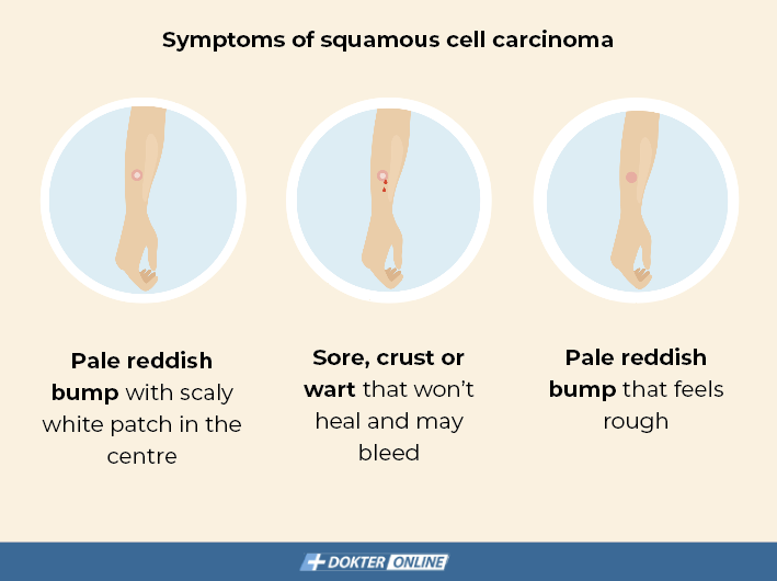 Symptoms of squamous cell carcinoma - EN