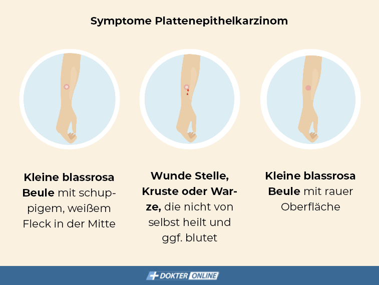 Symptome Plattenepithelkarzinom - DE