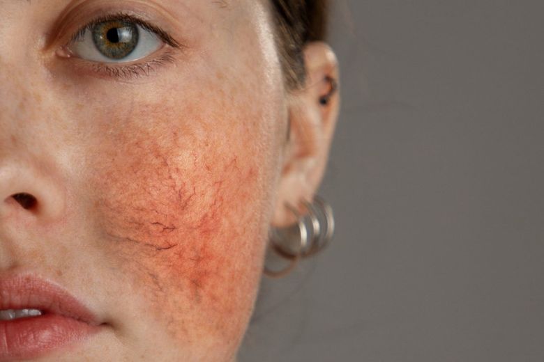 Rosacea